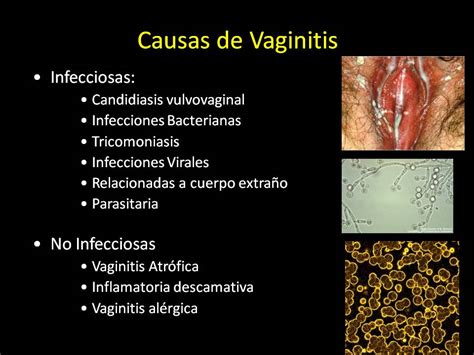 infeccin vajinal fotos reales|Descubre qué tipos de infecciones vaginales hay I Dr.